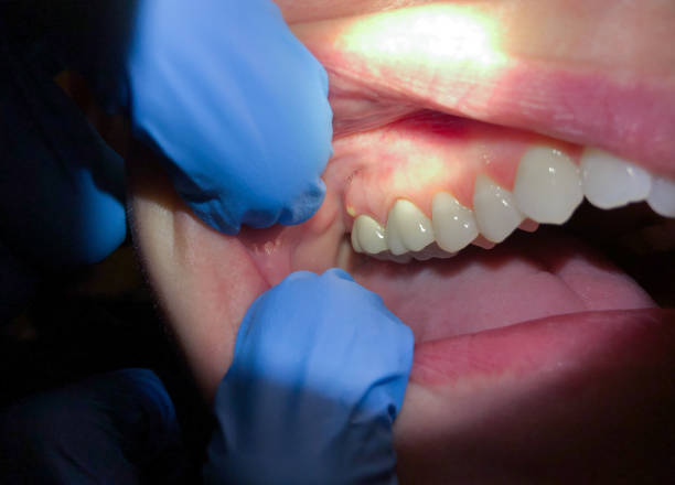 Best Emergency Dentist for Knocked-Out Tooth in Brushy Creek, TX